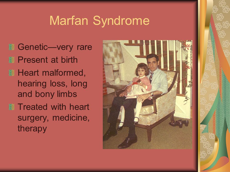 An overview of the rare hereditary disorder marfan syndrome